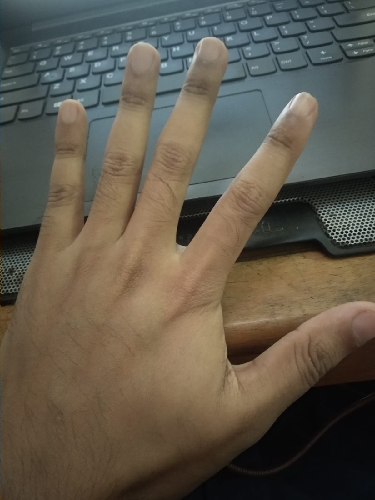 Perbandingan kondisi tangan kiri dan kanan Jemmy